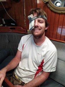 Jon after the red paper wasp stung his eye